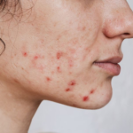Acné